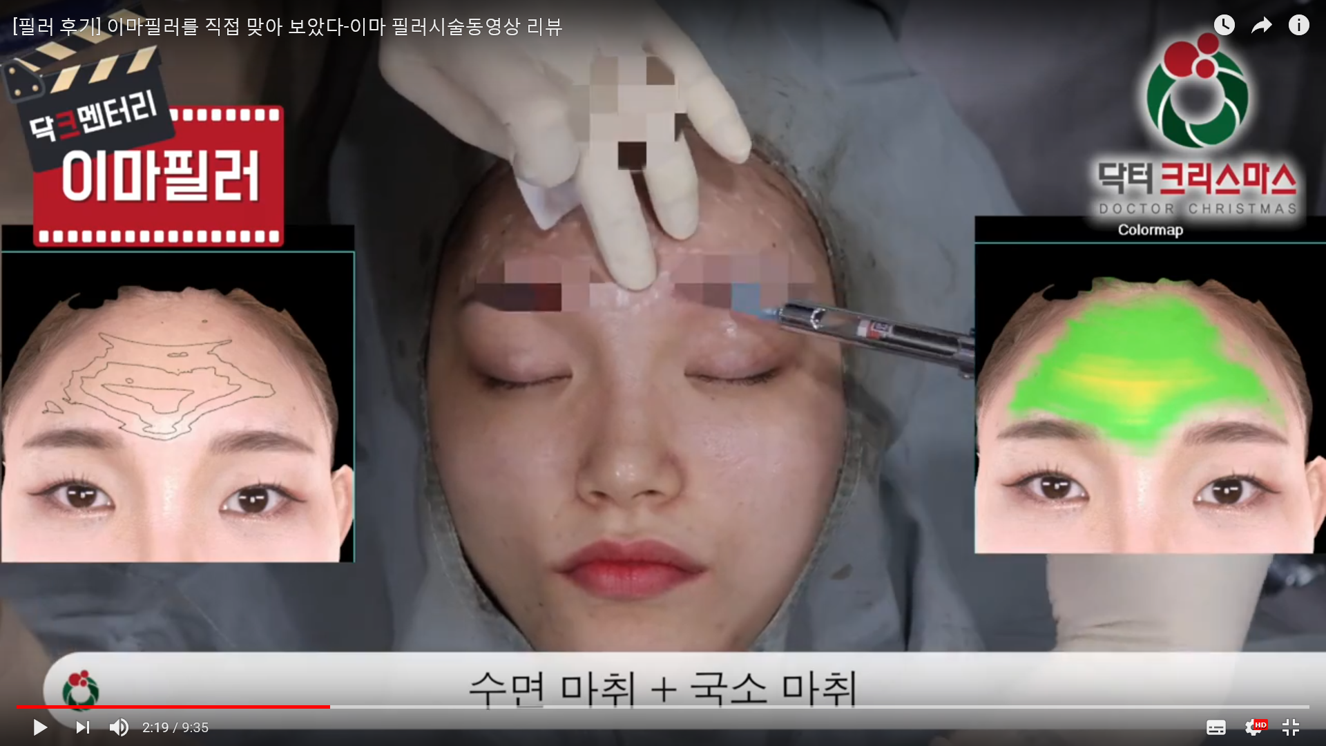 크리스마스성형외과 미디어/보도자료 - 메디칼 뷰티 리뷰 채널 [닥터 크리스마스] - [필러 후기] 이마필러를 직접 맞아 보았다-이마 필러시술동영상  리뷰